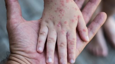 Alert Campak Australia Barat dan Standar Monitoring Ketat